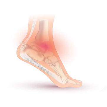 Cycling on a Swollen and Sprained Ankle 5. Cycling with a Sprained Ankle: When is it Recommended?