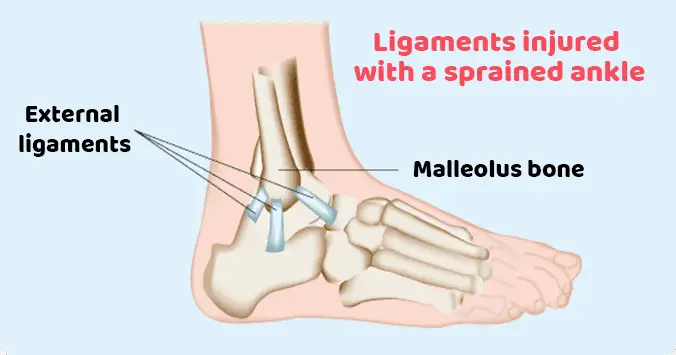 sprained ankle ligaments